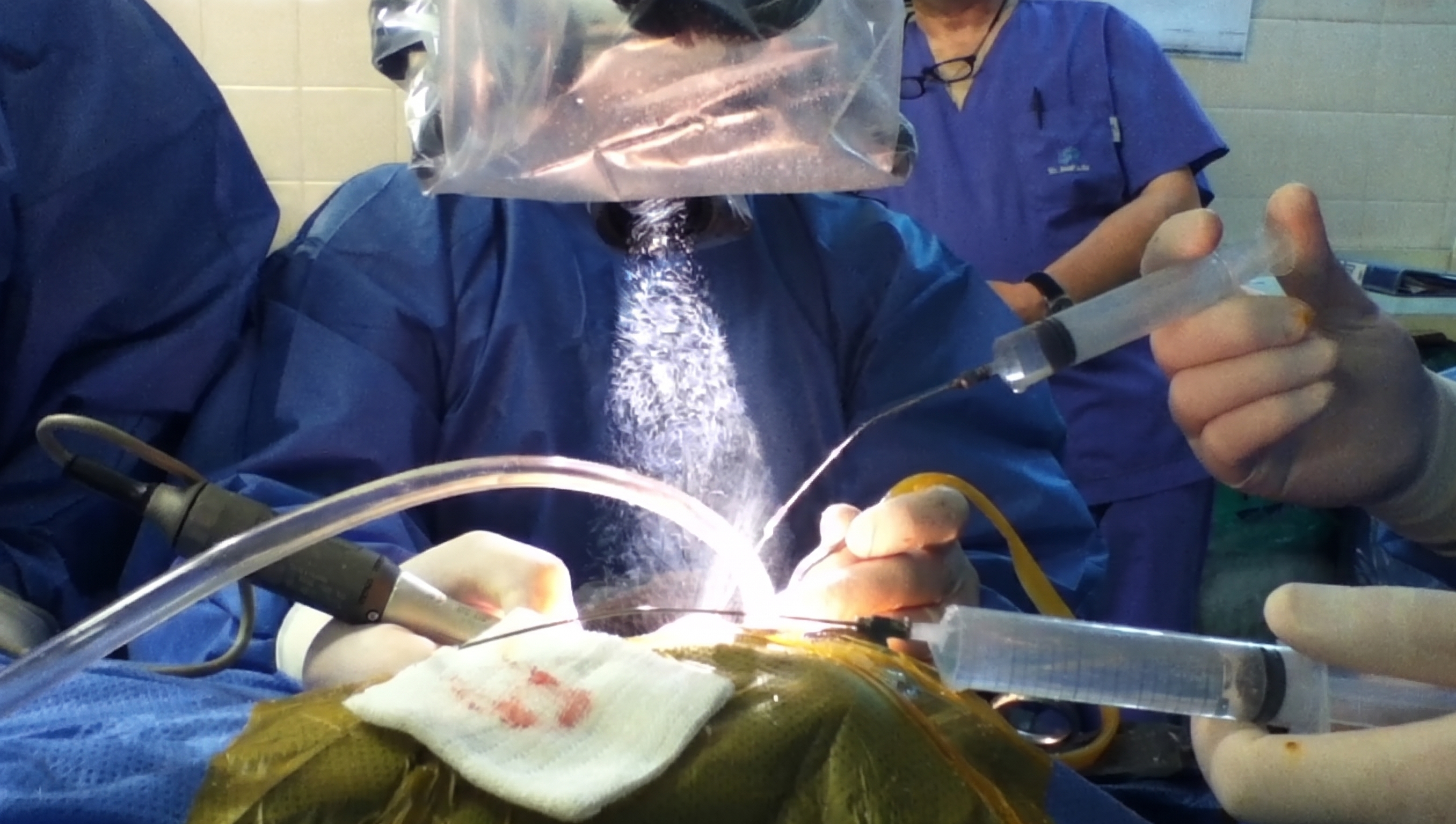 Procedimiento de timpanoplastia